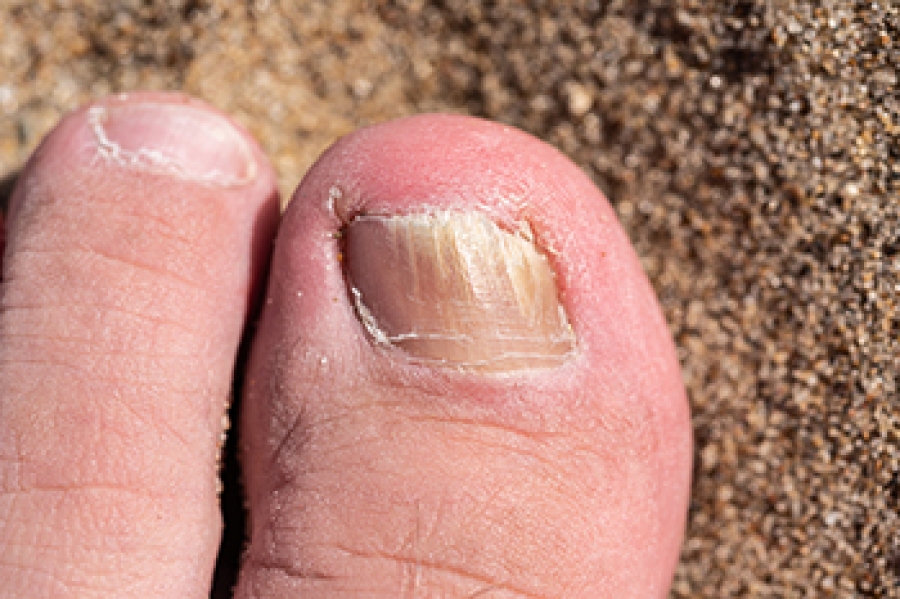 is-laser-treatment-right-for-my-toenail-fungus